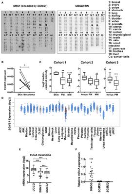 Sphingomyelin Synthase 1 (SMS1) Downregulation Is Associated With Sphingolipid Reprogramming and a Worse Prognosis in Melanoma